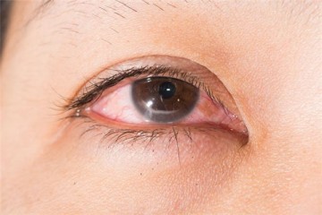 Pink eye when swimming | Causes, signs and prevention!